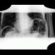 Ileus, small bowel obstruction, SBO: X-ray - Plain radiograph